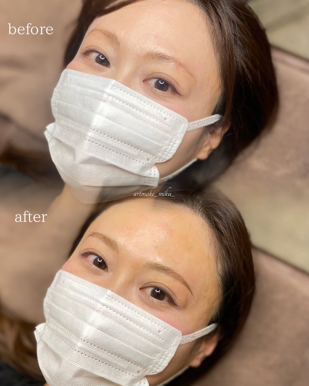 アートメイク1回目直後 before after