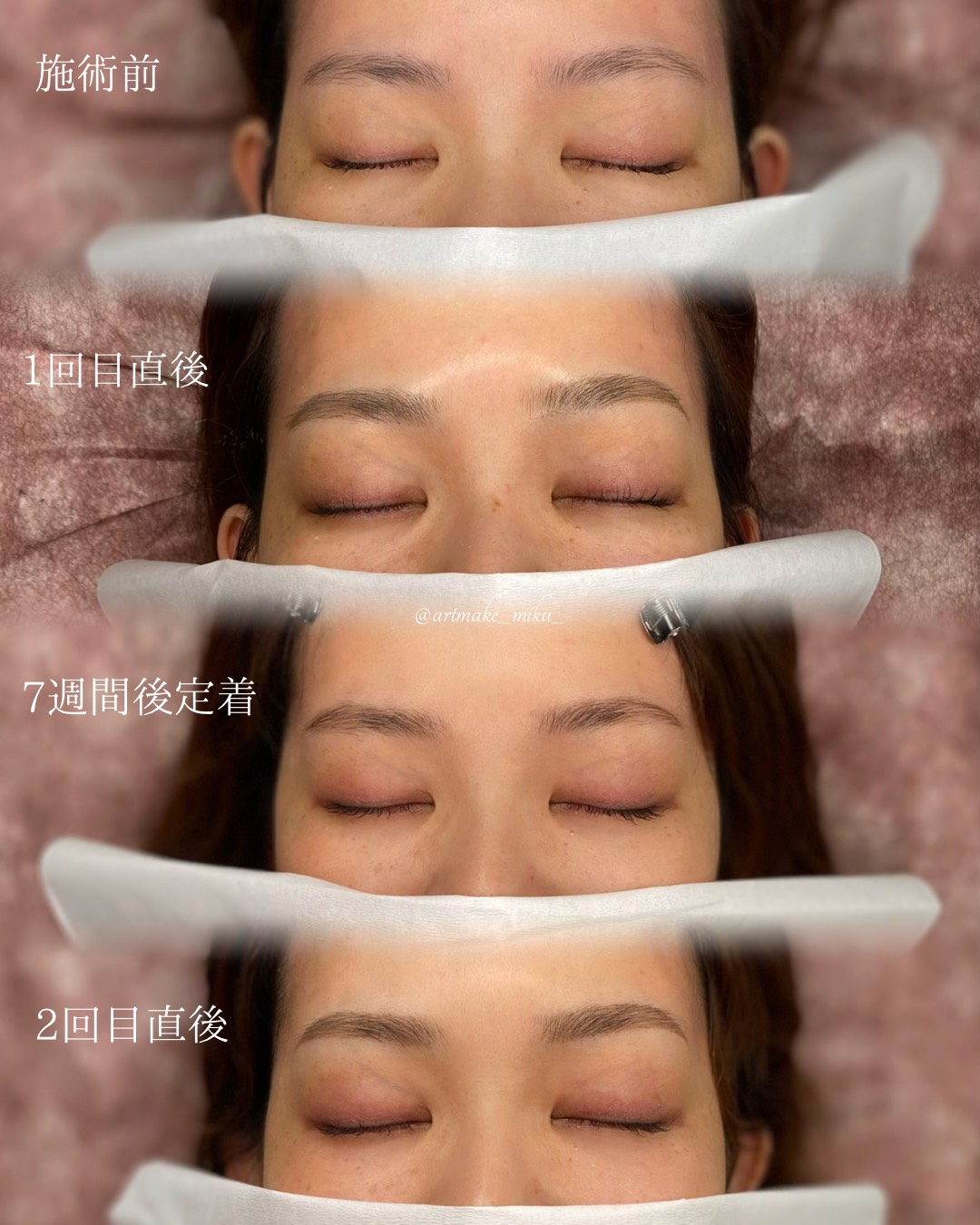 アートメイク1回目直後 before after