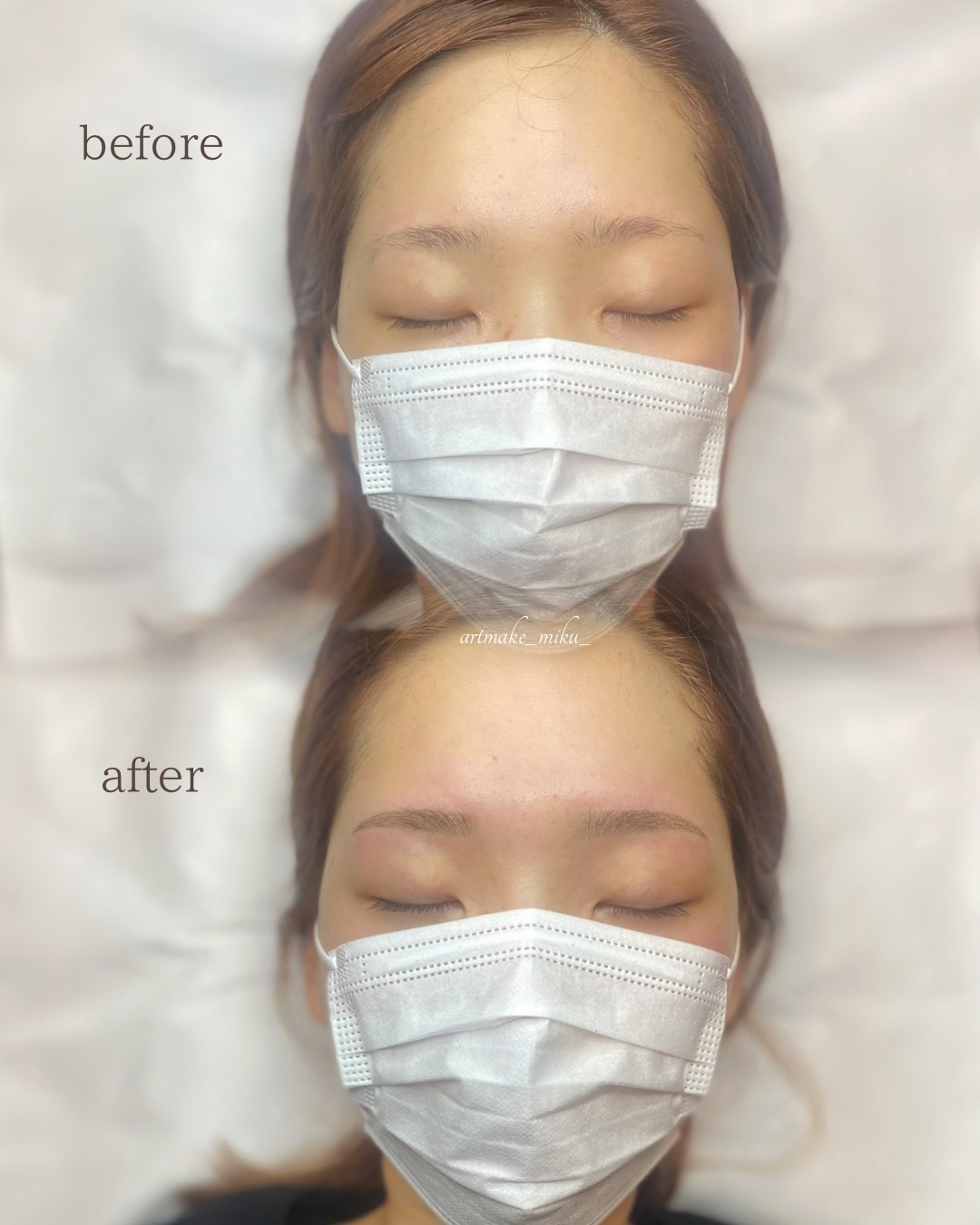 アートメイク1回目直後 before after
